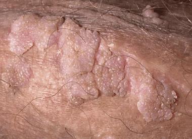 Hpv Lip Warts