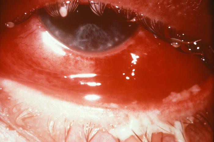 Gonorrhea infection of the eye