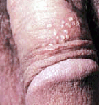 herpes picture on male