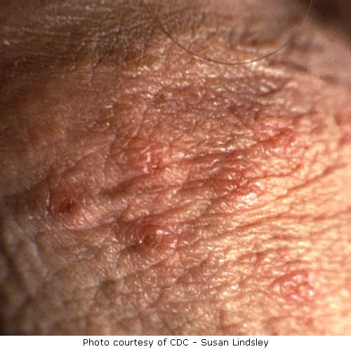 herpes pictures. Close Up Herpes picture on