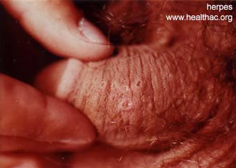 close up herpes picture on male