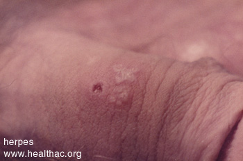 Healing Herpes Blister on male