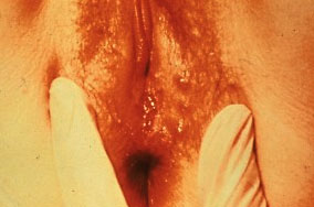 Herpes Blisters Vagina
