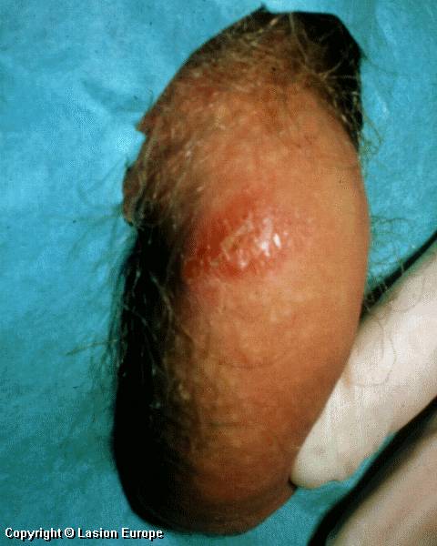 genital herpes images