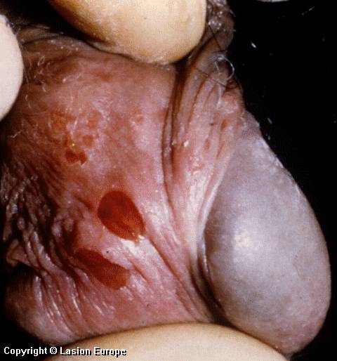 Crusted Herpes Blisters