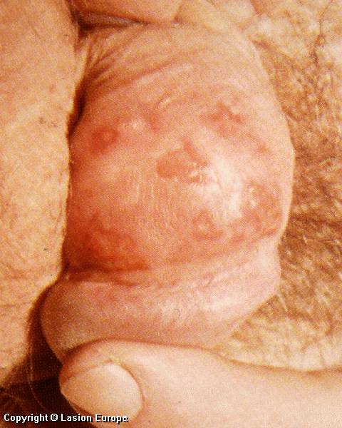 herpes pictures men. genital-herpies