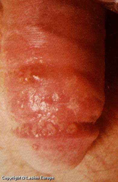 Pictures Of Blisters On Penis 5
