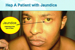 jaundice virus