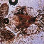 Scabies Under Microscope