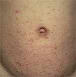 Scabies Rash on Stomach