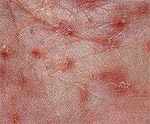 Scabies up Close